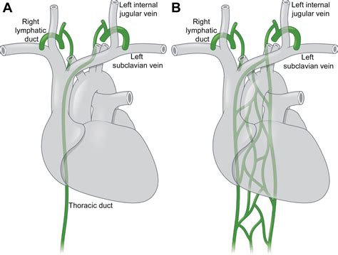 Understanding Lymphatic Anatomy And Abnormalities At Imaging