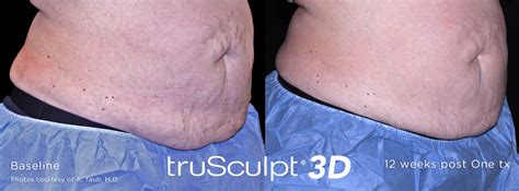 Trusculpt 3d Lifetime Dermatology