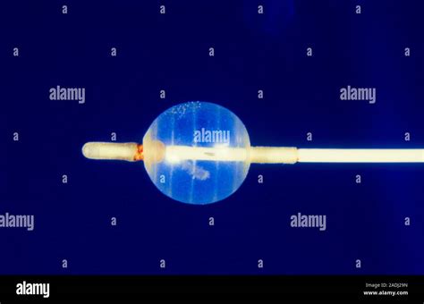 Fogarty embolic catheter, a balloon-carrying catheter used to remove an ...