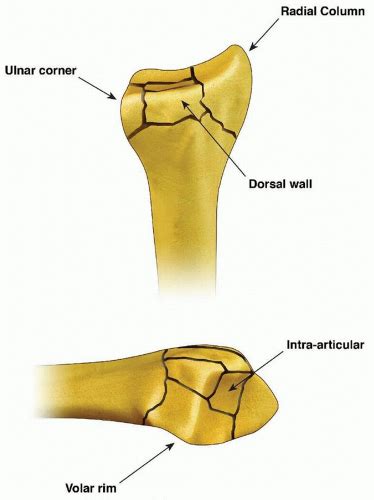 Fragment Specific Fixation Of Distal Radius Fractures Musculoskeletal Key