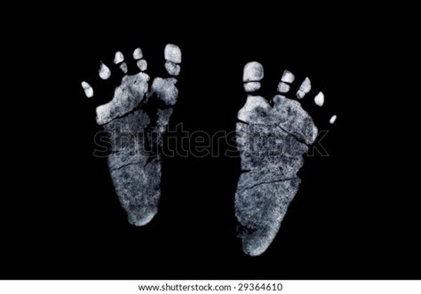 Newborns Little Girl Turner Syndrome Feet Stock Photo (Edit Now) 29364610