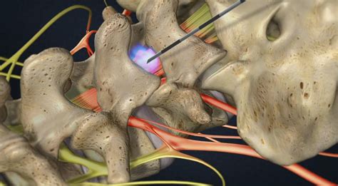 Epidural Steroid Injection (ESI) - Lumbar Spine