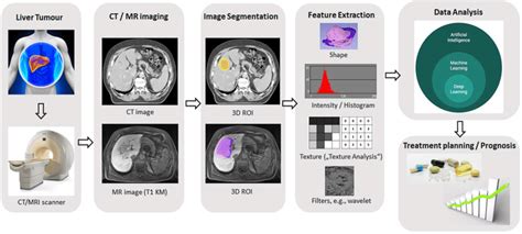 Exemplary Radiomics Workflow For Liver Imaging Schematic Illustration