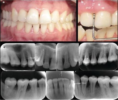 Aggressive Periodontitis Medizzy