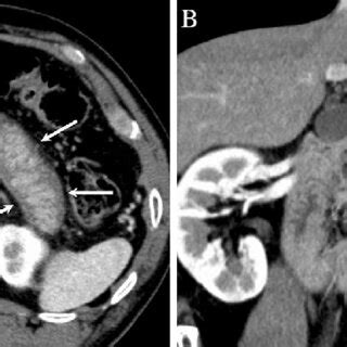 Figure1 Abdominal Arterial Phase Enhanced Computed Tomography CT