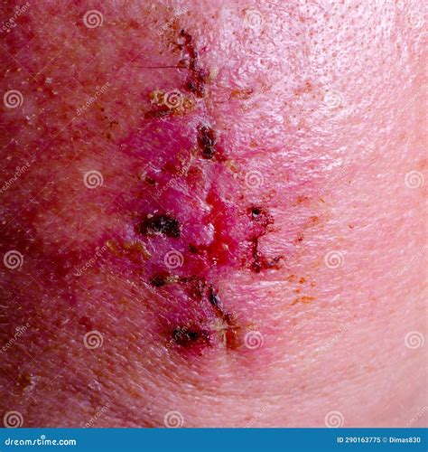 Wound After Removal Of Stitches After Skin Cancer Surgery Stock Image