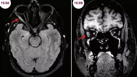 Unilateral Ophthalmoplegia Ppt