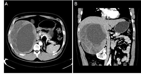 Figure 1 From Transperitoneal Laparoscopic Adrenalectomy For A Large