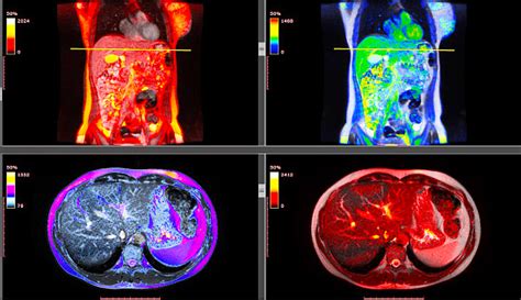 Pencitraan Radiologi Tubuh Manusia Perut Mri Resolusi Tinggi Foto Stok