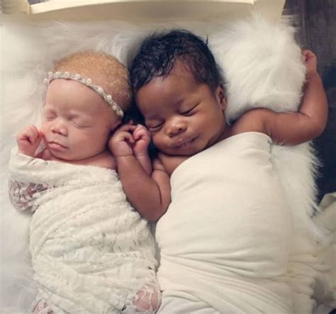 Twins With Different Skin Colors | Others