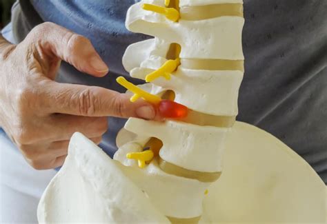 Bone Spurs Osteophytes Causes Symptoms Treatment