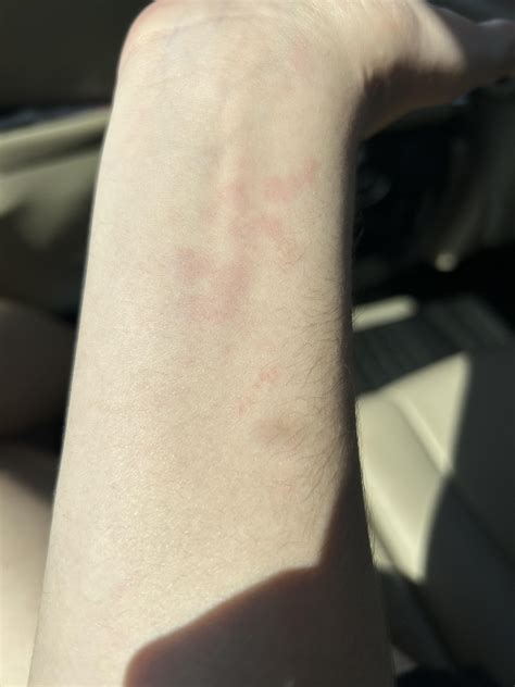 Weird Rash On Wrist Rdermatologyquestions