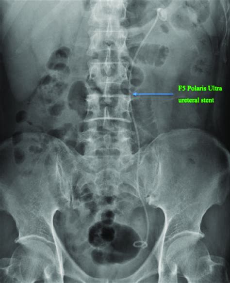 An X Ray Of Patient 1 Showing That An F5 Polaris Ultra Ureteral Stent