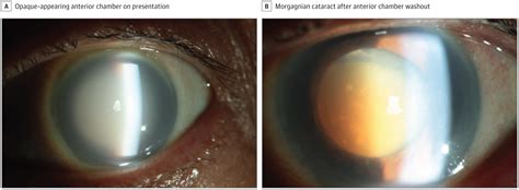 Acute Phacolytic Glaucoma And Morgagnian Cataract Cataract And Other