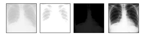 Solved 12how Does A Planar Chest X Ray Image Chest Radiograph Look