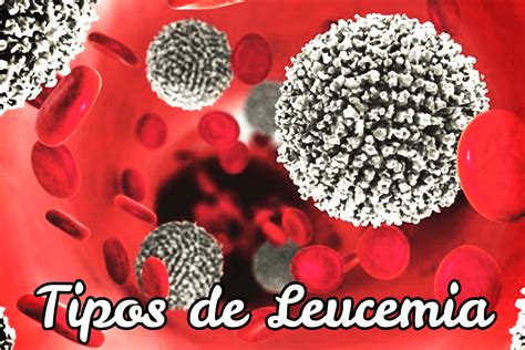 Quais São Os 12 Tipos De Leucemia - Quais Os Tipos De Leucemia - NAZAEDU