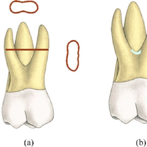 Palatal Canal System Of Maxillary First Molar Reprinted From 3d Tooth