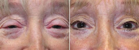 Upper Blepharoplasty Lower Blepharoplasty Dark Circles Treatment