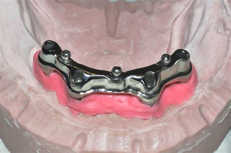 Implant-anchored Dentures Provide a Secure Smile