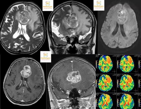 Neuroradiology Cases Spotter Set 73 RadioGyan