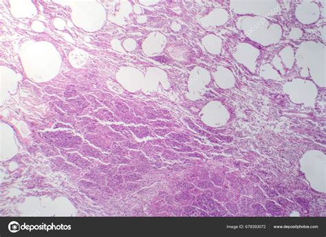 Fotomicrografía Neumonía Intersticial Que Muestra Inflamación Fibrosis