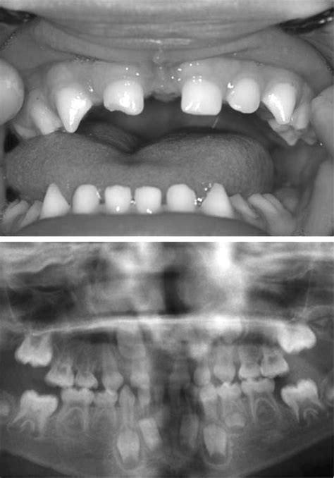 Ectodermal Dysplasia Teeth