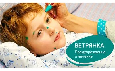 Ветрянка Картинки - 73 фото