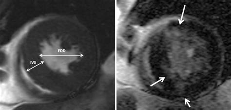 Left Ventricular Outflow Tract Radiology Key