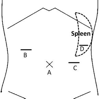 The Position Of The Trocars Trocars A And B Were Used By The Surgeon