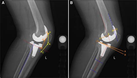 Frontiers 3d Printed Patient Specific Instrumentation Decreases The