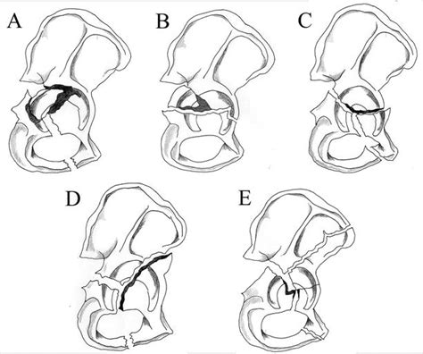 Clinical And Radiological Assessment Of Acetabular Fracture Intechopen