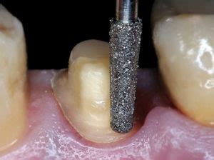 Preparation - DentalCrown.com