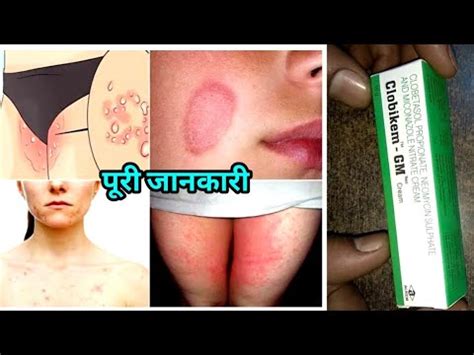 Clobikem Gm Cream Uses Side Effects In Hindi Clobenate Gm Cream Use In