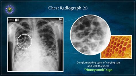 Bronchiectasis - causes and diagnosis