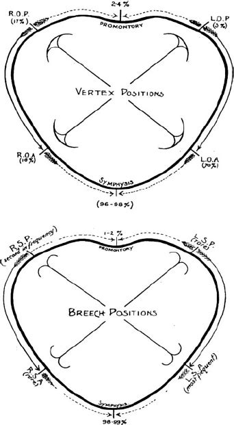 Frequency Of Fetal Presentation With Vertex And Breech Positions 1