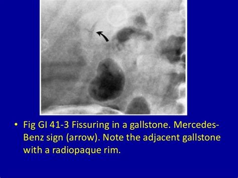 41 Filling Defects In An Opacified Gallbladder