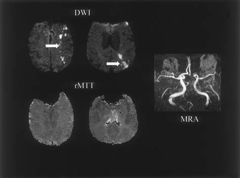 Diffusion And Perfusion Weighted Mri Patterns In Borderzone Infarcts