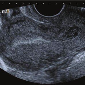 Longitudinal Transvaginal Ultrasound Image Of An Early Intrauterine