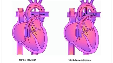 Ductus Arteriosus Persistens Dap Klinika Digjitale