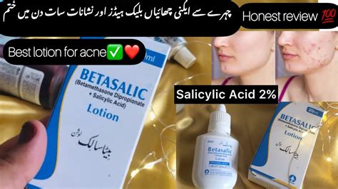 Betasalic Lotion Review Get Rid Of Acne White And Black Heads YouTube