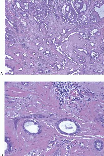 Adenosis And Sclerosing Lesions Oncohema Key