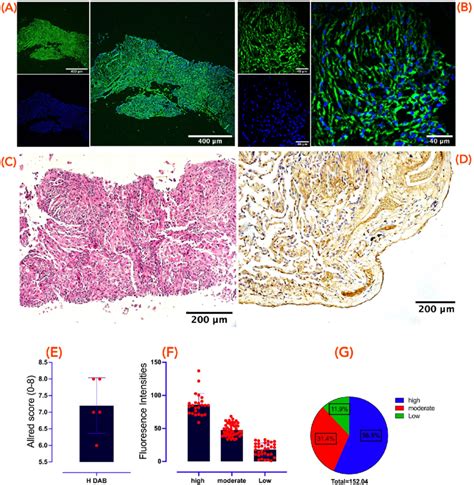 Immuno Fluorescence And Immunohistochemistry Of Lung Cancer Biopsy