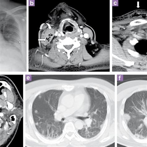 A Antero Posterior Ap Supine Chest Radiograph At Presentation A