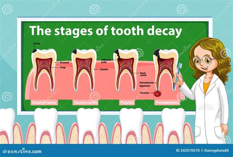 Infographic Of Human In The Stages Of Tooth Decay Stock Vector