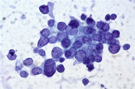 Histopathological Variants Of Papillary Carcinoma Thyroid