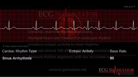 Sinus Arrhythmia Ecg Ekg Youtube