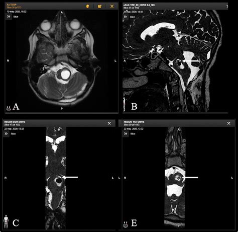 Frontiers The Impact Of 1 5 T Intraoperative Magnetic Resonance