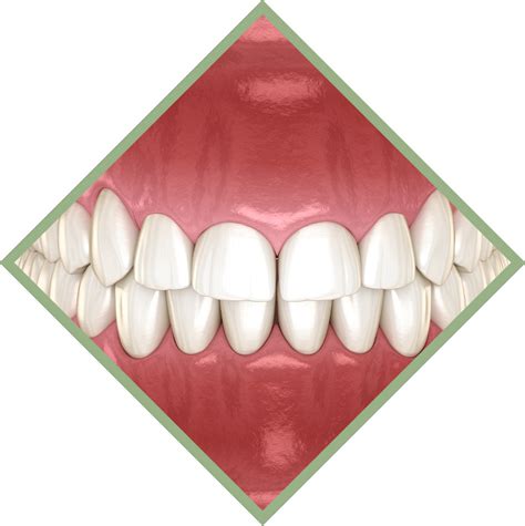 Crown Lengthening | Hagerstown, MD | Smile Design Centre