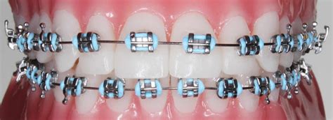 Understanding Metal Braces For Orthodontic Treatment