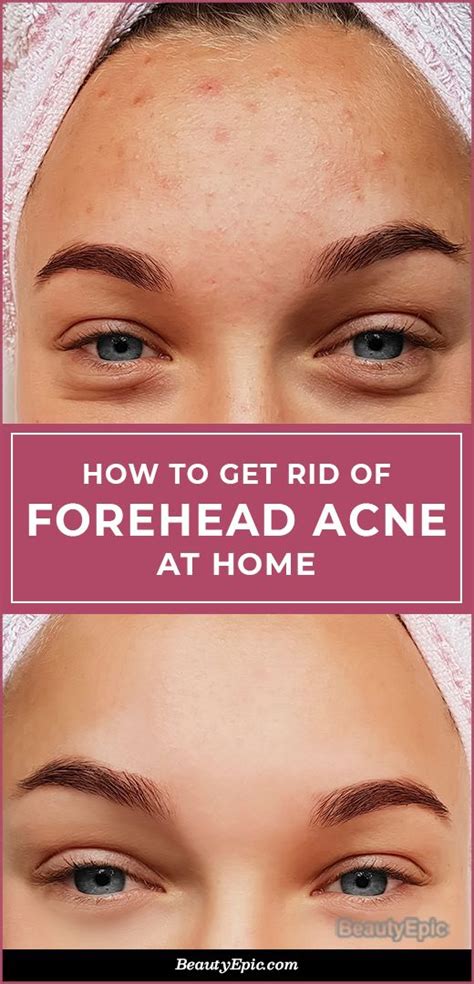 Forehead Acne Heres How To Treat At Home Forehead Acne Forehead